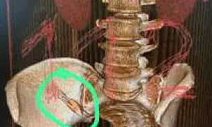 Сочинские врачи забыли скальпель в теле пациентки, у которой четвертая стадия рака