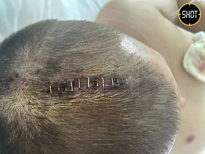 в турции россиянину скрепили голову скобами после того, как его избили сотрудники отеля (видео) - Сайт Газеты «Совершенно Секретно»