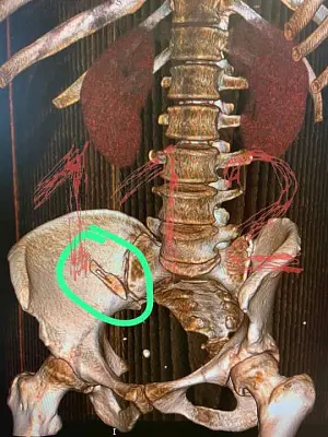 сочинские врачи забыли скальпель в теле пациентки, у которой четвертая стадия рака - Сайт Газеты «Совершенно Секретно»
