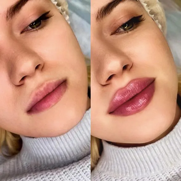 увеличение губ до и после